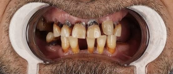 الحالة رقم 1 قبل العلاج في مركز د. أسامة عامر للأسنان