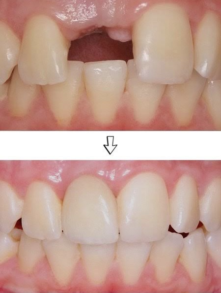 implant5