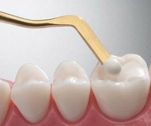 الحشوات التجميلية في مركز د. أسامة عامر